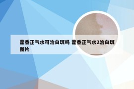 藿香正气水可治白斑吗 藿香正气水2治白斑图片