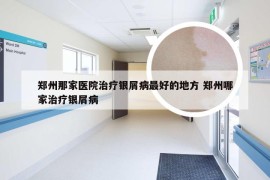 郑州那家医院治疗银屑病最好的地方 郑州哪家治疗银屑病