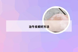 治牛皮癣好方法