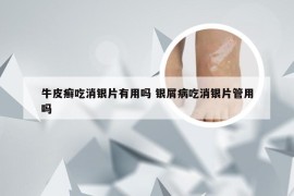 牛皮癣吃消银片有用吗 银屑病吃消银片管用吗