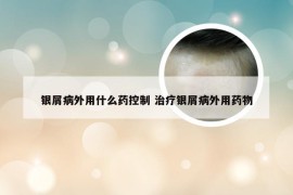 银屑病外用什么药控制 治疗银屑病外用药物