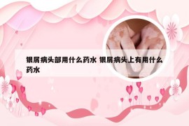 银屑病头部用什么药水 银屑病头上有用什么药水