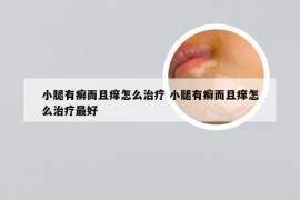 小腿有癣而且痒怎么治疗 小腿有癣而且痒怎么治疗最好