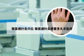 银屑病针灸穴位 银屑病针灸需要多久才能好