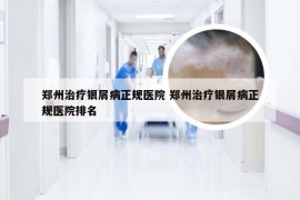 郑州治疗银屑病正规医院 郑州治疗银屑病正规医院排名