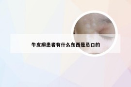 牛皮癣患者有什么东西是忌口的