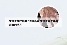 吉林省皮肤科那个医院最好 吉林省看皮肤病最好的地方