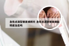 急性点滴型银屑病照片 急性点滴状银屑病能彻底治愈吗