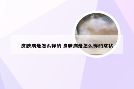 皮肤病是怎么样的 皮肤病是怎么样的症状