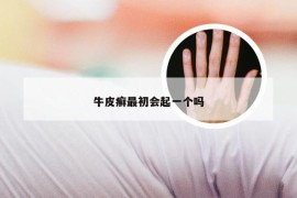 牛皮癣最初会起一个吗