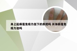 身上起癣是免疫力低下的表现吗 长体藓是免疫力低吗