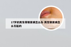 17岁的男生得银屑病怎么办 男性银屑病怎么引起的