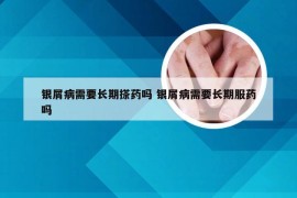 银屑病需要长期搽药吗 银屑病需要长期服药吗