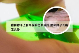 脸和脖子上有牛皮癣怎么治疗 脸和脖子长癣怎么办