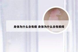 身体为什么会有癣 身体为什么会有癣痒