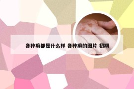 各种癣都是什么样 各种癣的图片 初期