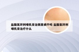 盐酸氯环利嗪乳膏治银屑病干吗 盐酸氯环利嗪乳膏治疗什么