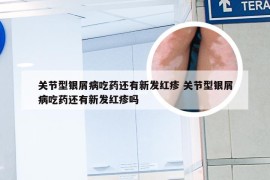 关节型银屑病吃药还有新发红疹 关节型银屑病吃药还有新发红疹吗