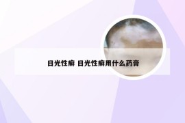 日光性癣 日光性癣用什么药膏