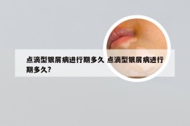 点滴型银屑病进行期多久 点滴型银屑病进行期多久?