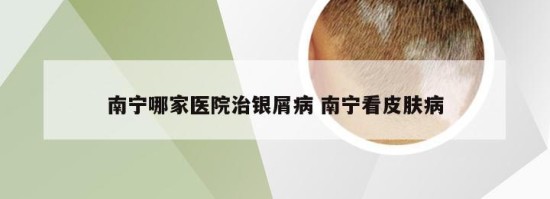 南宁哪家医院治银屑病 南宁看皮肤病