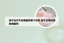 南宁治疗牛皮癣医院哪个好啊 南宁正规的皮肤病医院