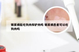 银屑病能吃狗肉和驴肉吗 银屑病患者可以吃狗肉吗