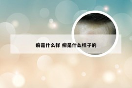 癣是什么样 癣是什么样子的