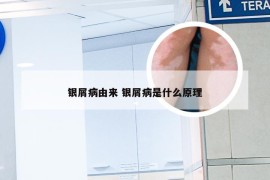 银屑病由来 银屑病是什么原理