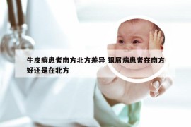 牛皮癣患者南方北方差异 银屑病患者在南方好还是在北方