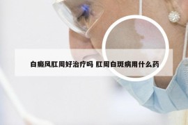 白癜风肛周好治疗吗 肛周白斑病用什么药