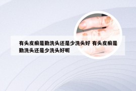 有头皮癣是勤洗头还是少洗头好 有头皮癣是勤洗头还是少洗头好呢