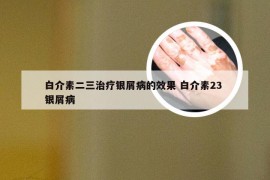 白介素二三治疗银屑病的效果 白介素23 银屑病