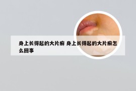 身上长得起的大片癣 身上长得起的大片癣怎么回事