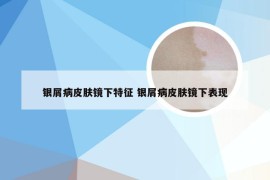 银屑病皮肤镜下特征 银屑病皮肤镜下表现