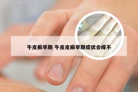 牛皮癣早期 牛皮皮癣早期症状会痒不