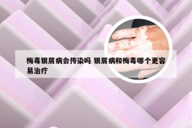 梅毒银屑病会传染吗 银屑病和梅毒哪个更容易治疗