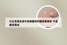 什么洗发水洗牛皮癣最好的医院是哪家 牛皮廨洗发水