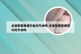 点滴型银屑病不能吃牛肉吗 点滴型银屑病可以吃牛肉吗