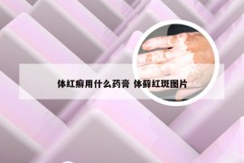 体红癣用什么药膏 体藓红斑图片