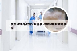 多形红斑与点滴型银屑病 红斑型银屑病的病症