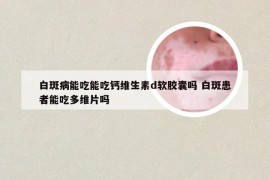 白斑病能吃能吃钙维生素d软胶囊吗 白斑患者能吃多维片吗