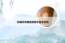 白癜风早期症状照片是怎样的