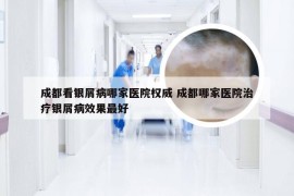 成都看银屑病哪家医院权威 成都哪家医院治疗银屑病效果最好