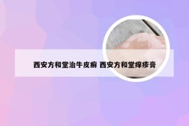 西安方和堂治牛皮癣 西安方和堂痒疹膏