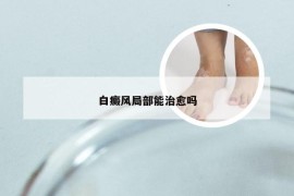 白癜风局部能治愈吗