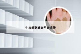 牛皮癣到底会不会遗传