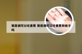 银屑病可以吃香蕉 银屑病可以吃香蕉和橘子吗