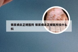 银屑病去正规医院 银屑病去正规医院挂什么科