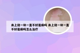 身上挠一块一直不好是癣吗 身上挠一块一直不好是癣吗怎么治疗